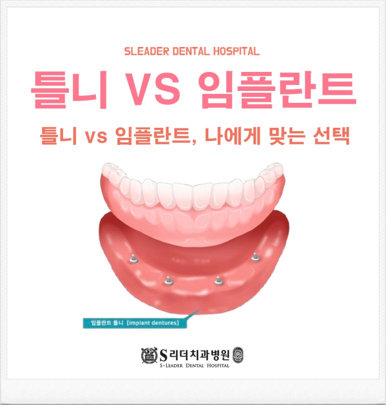 [서울임플란트] 틀니 vs 임플란트, 나에게 맞는 선택을 찾는 기준 관련 이미지 1