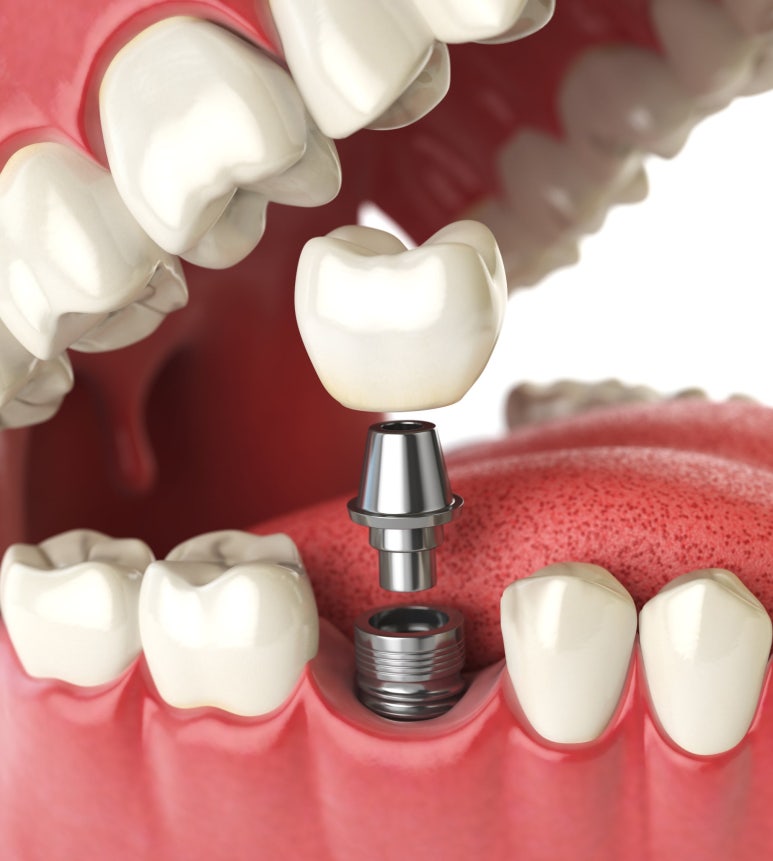 Hwanyang-dong Dental Clinic: Can Bone Grafting and Implant Placement Be Performed at the Same Time? image 6