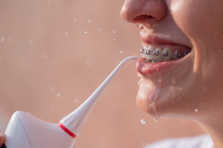Mangu-dong Dental Clinic: Why Food Keeps Getting Stuck Between Your Teeth During Orthodontic Treatment and How to Manage It image 9