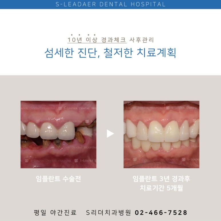 [Gwangjin-gu Implant] Important Things to Check Before Getting a Molar Implant and Its Cost image 5