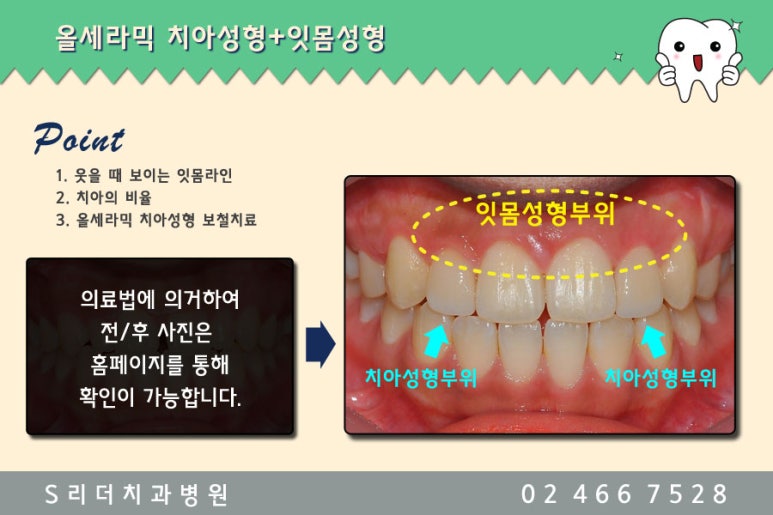 광진구치과 치아성형으로 컴플렉스 극뽁~ 관련 이미지 3