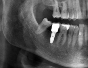 Three Things to Know Before Getting Dental Implants at a Gwangjin-gu Dental Clinic image 5