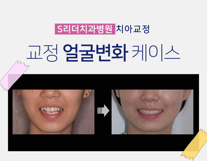 건대입구교정치과 교정얼굴변화 확인해보자 관련 이미지 6