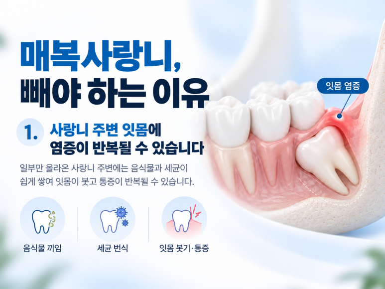 광진구치과병원 매복 사랑니는 왜 발치가 필요할까요? 관련 이미지 3