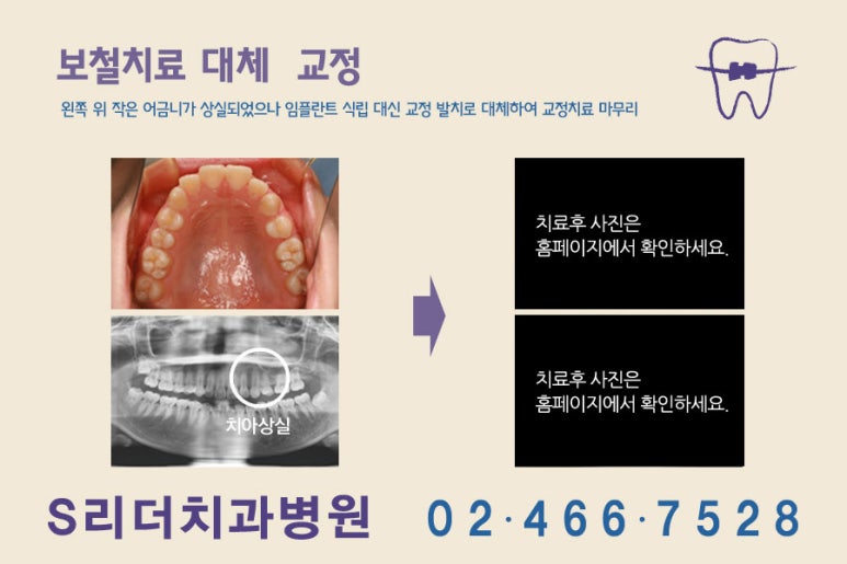 건대치아교정 사랑니로 교정까지.. 관련 이미지 2
