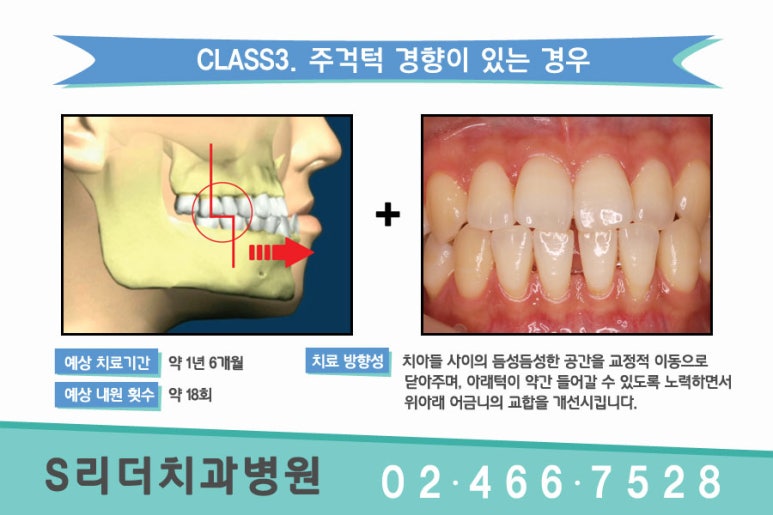 건대교정치과 듬성듬성 벌어진 치아가 고민이라면.. 관련 이미지 5