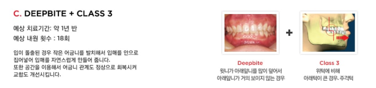 건대치과 주걱턱교정 부정교합3급치아교정 고려한다면 관련 이미지 4