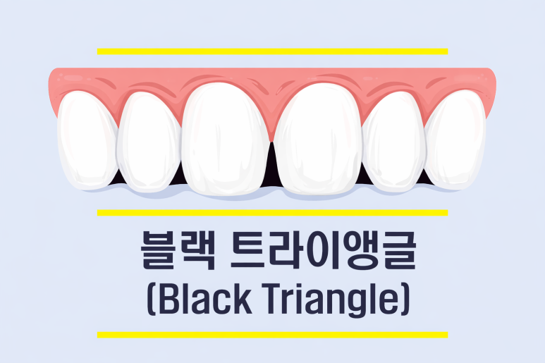 아차산역치과｜블랙트라이앵글이 점점 커지는 느낌&hellip; 잇몸병 신호일까요? 관련 이미지 2