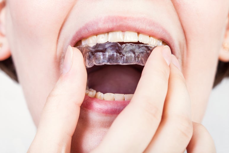 사가정역치과 교정장치 종류별 장단점 한눈에 정리, 나에게 맞는 선택 기준까지 관련 이미지 7