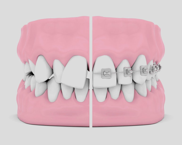 Sungsu-dong Dental Clinic, Why Does the ‘Black Triangle’ That Looks Like Loose Stitches Appear After Orthodontic Treatment? image 4