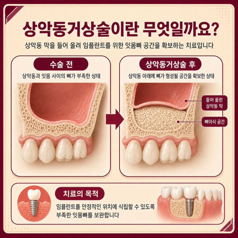 송정동치과 잇몸뼈가 부족하면 상악동거상술을 꼭 해야 할까요? 관련 이미지 3