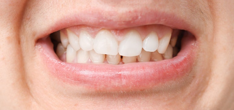 Sungsu-dong Dental Clinic, Why Does the ‘Black Triangle’ That Looks Like Loose Stitches Appear After Orthodontic Treatment? image 7