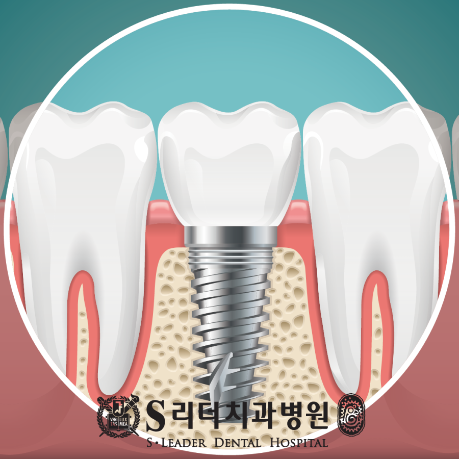면목동치과 임플란트수술 기간 궁금한점 살펴볼까요 관련 이미지 1