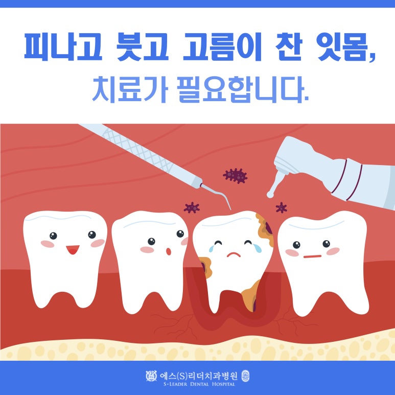 [Jungnang-gu Dental Clinic] Gums that bleed, swell, and contain pus need treatment. image 1