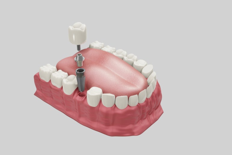 If Your Gums Are Weak, Is Implant or Orthodontic Treatment Possible? Dental Diagnosis Criteria in Dongdaemun-gu image 5