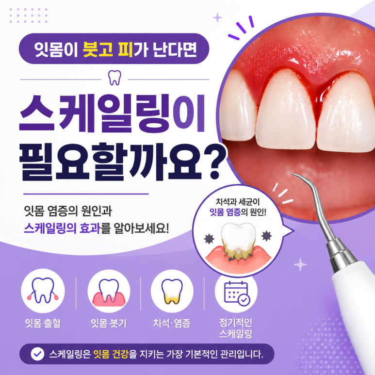 군자역치과 잇몸이 붓고 피가 난다면 스케일링이 필요할까요? 관련 이미지 1