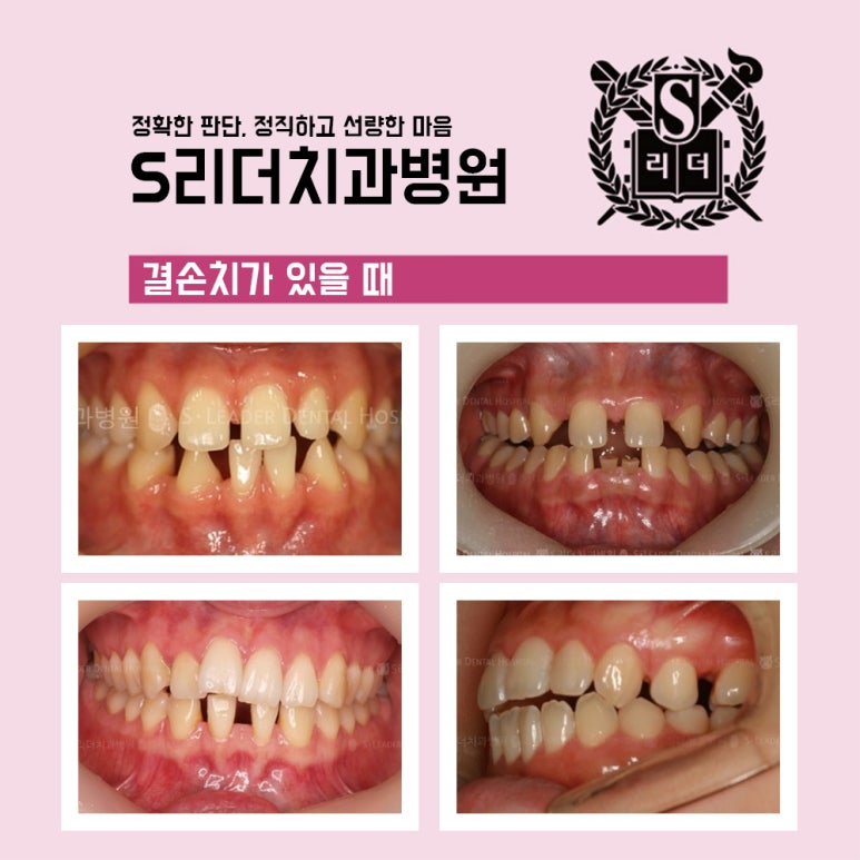 광진구교정치과 결손치치아교정 잘하는치과에서 살려볼점은 관련 이미지 2