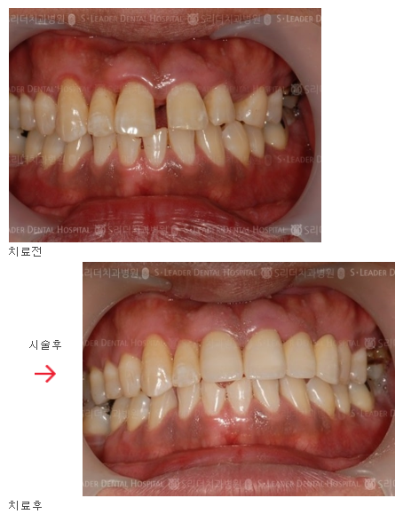 [사가정역치과] 벌어진 앞니가 너무 스트레스일 땐? 심미보철로 해결하기! 관련 이미지 6