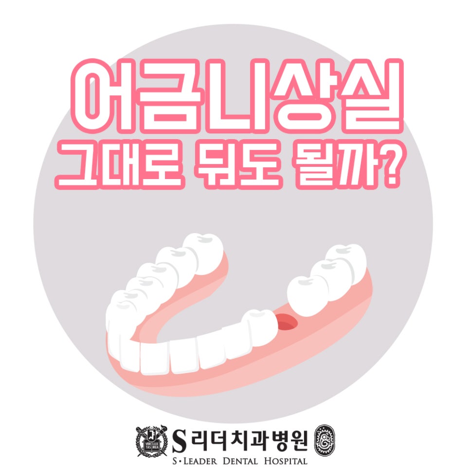 어금니깨짐 부러짐 깊은 파절 방치하지 말고 관련 이미지 1