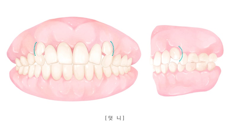 Jungnang-gu Orthodontic Clinic: Can protruding buck teeth be corrected with partial orthodontics? image 4
