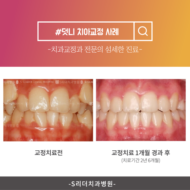 용마산역치과, 덧니 주걱턱 치아교정 개선하기 위한 과정은 관련 이미지 7