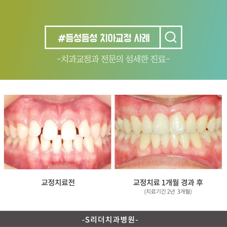 Junggok-dong Dental Clinic: Is the Pain Felt During Orthodontic Treatment Within the Normal Range? image 5