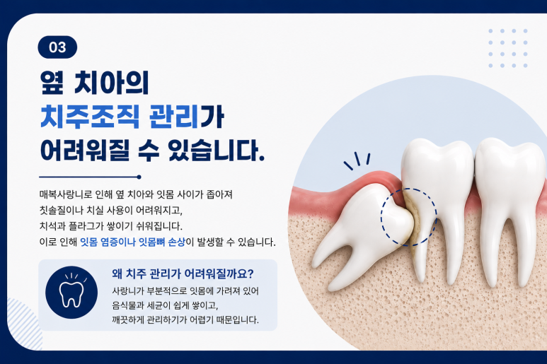 건대입구치과, 매복 사랑니가 옆 치아에 영향을 줄 수도 있을까요? 관련 이미지 6
