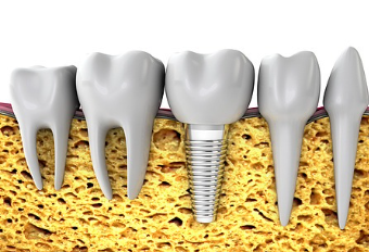 Three Things to Know Before Getting Dental Implants at a Gwangjin-gu Dental Clinic image 6