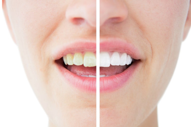 Myeonmok-dong Dental Clinic: How Should You Manage Yellow Teeth? image 5