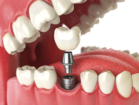 Three Things to Know Before Getting Dental Implants at a Gwangjin-gu Dental Clinic image 4