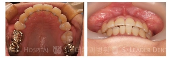 [Mangu-dong Dental Clinic] Cases Requiring Orthodontic Treatment: Protruding Jaw or Crossbite image 2