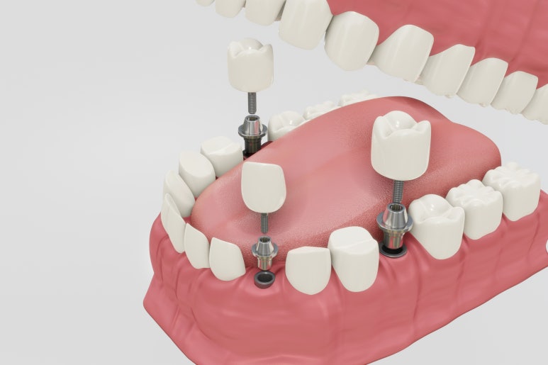 [Sagajeong Station Dental Clinic] Implant Prosthetic Peri-implantitis: How Can It Be Prevented? image 2
