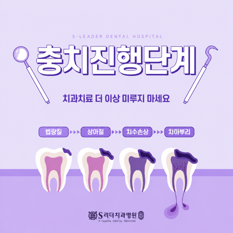 Sanggye-dong Dental Clinic: Step-by-Step Process of Cavity Treatment and Why Treatment Differs image 4