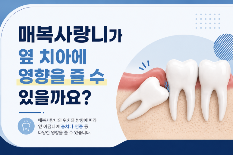 건대입구치과, 매복 사랑니가 옆 치아에 영향을 줄 수도 있을까요? 관련 이미지 3