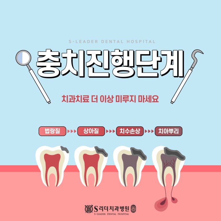 Konkuk University Dental Clinic Cavity Treatment by Stage｜A Clear Summary from Early Stage to Root Canal Treatment image 1