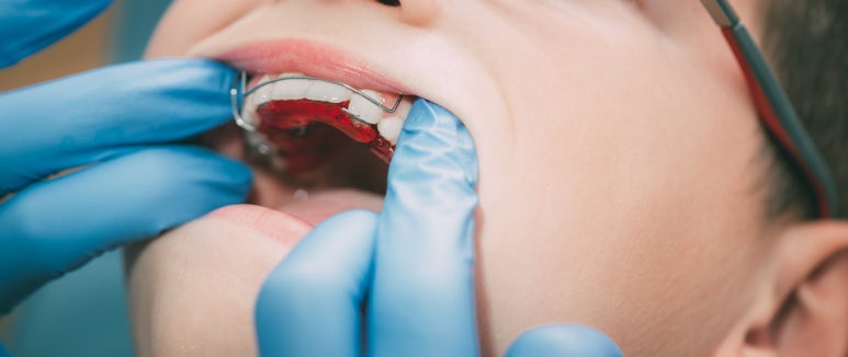 Seongsu-dong Dental Clinic: Why Is an Orthodontic Retainer Important? image 6