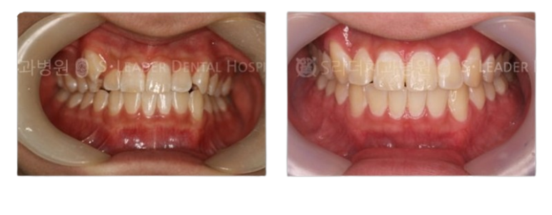 The Need for Orthodontic Treatment in Middle-Aged Adults and Precautions image 2