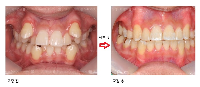 Seoul Yangsim Dental Clinic Laminate &middot; Orthodontic Treatment: Which Procedure Is Right for Me? image 2