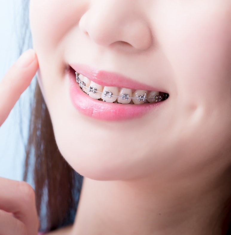 사가정역치과 교정 중 충치가 발견되면 치료는 어떻게 진행할까요? 관련 이미지 5