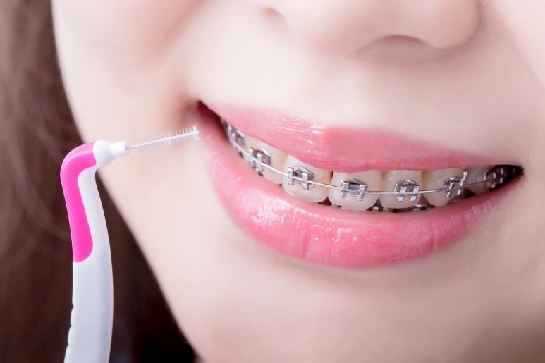 Seoul orthodontic clinic: Is the ‘change in face shape’ that happens during orthodontic treatment really real? image 4