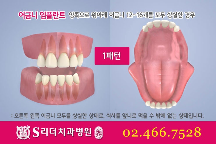 어금니임플란트 알면 좋은정보! 관련 이미지 4