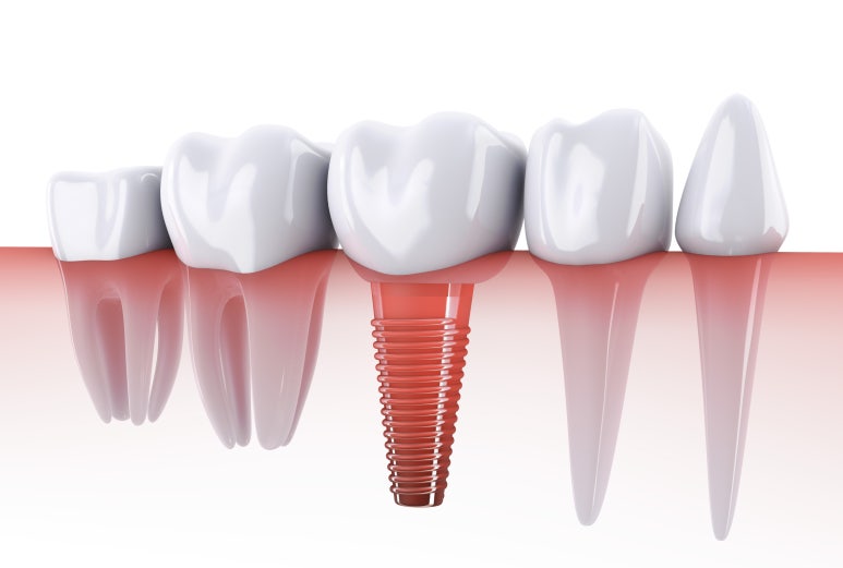 Sanggye-dong Implants | Why Bone Grafting Is Needed When There Is Not Enough Jawbone image 2