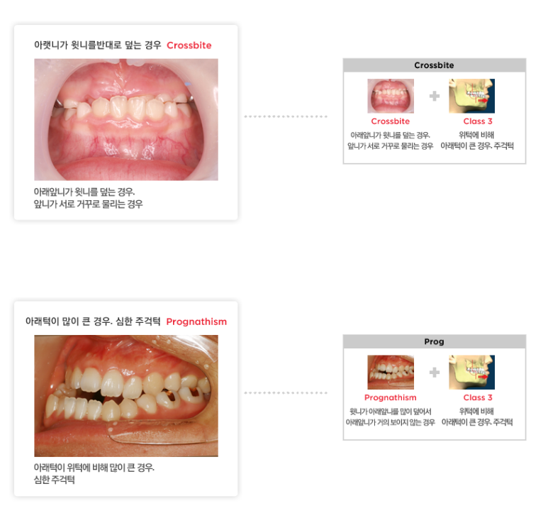 건대치과 주걱턱교정 부정교합3급치아교정 고려한다면 관련 이미지 3