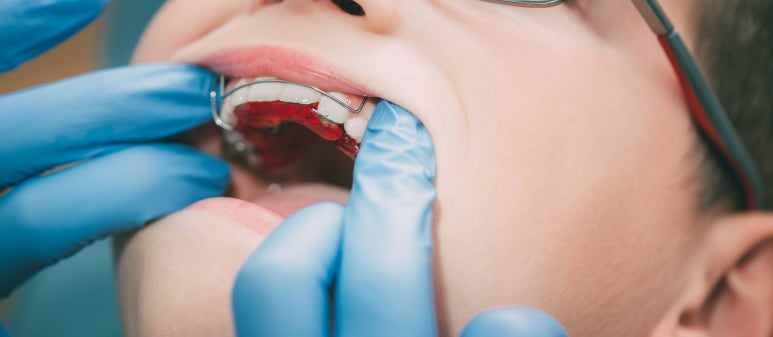 Nungdong Dental Clinic, Why Should You Wear a Retainer for at Least 1 Year? image 5