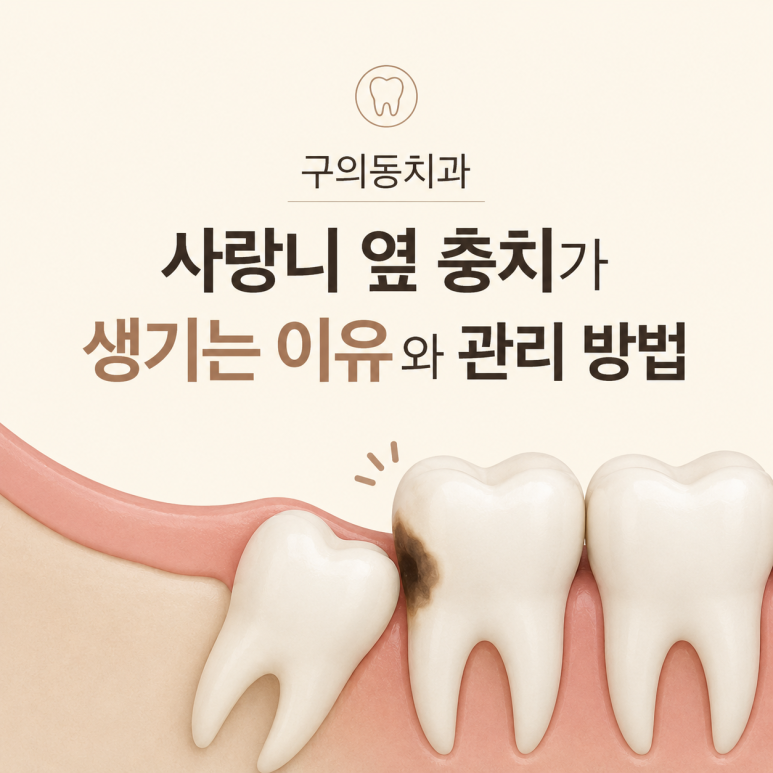 구의동치과｜사랑니 옆 충치가 생기는 이유와 관리 방법 관련 이미지 1