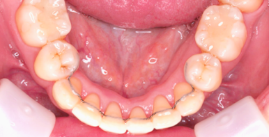 Jayang-dong Dental Clinic: Why Are Retainers Absolutely Necessary After Orthodontic Treatment? image 2