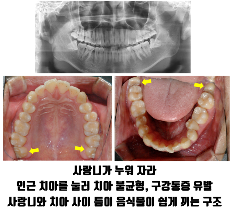 건대입구치과, 매복 사랑니가 옆 치아에 영향을 줄 수도 있을까요? 관련 이미지 8