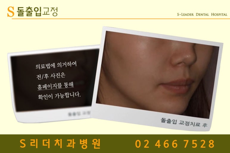 건대치아교정치과 수준높은 치아교정이 되려면 관련 이미지 4