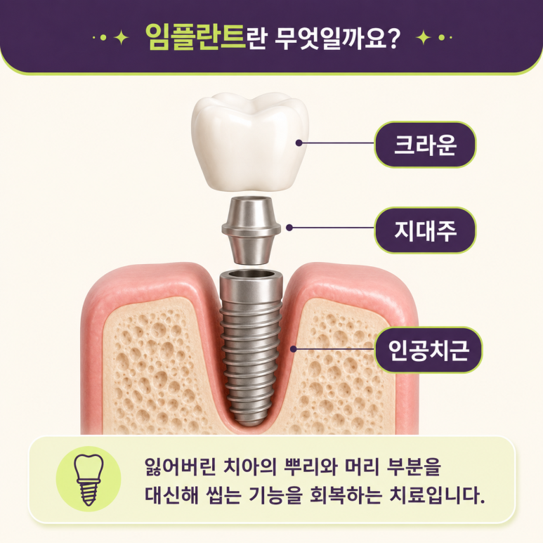 성수동임플란트, 치아 상실 후 임플란트·브릿지·틀니 어떤 차이가 있을까? 관련 이미지 3