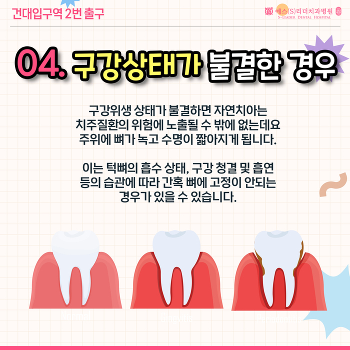 송정동치과 임플란트 안되는 사람들? 20대임플란트 가능한 시기 관련 이미지 6